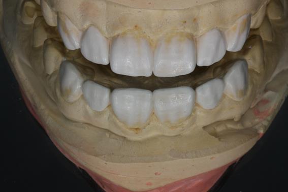 dentes anteriores, evidenciando a previsibilidade dos procedimentos. CASO CLÍNICO Paciente L.F.