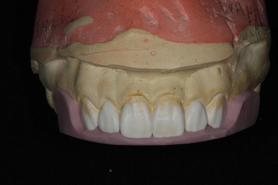 O guia de silicone para enceramento estético foi preenchido com resina bisacrílica e posicionado por 4 minutos sobre os dentes preparados para a polimerização inicial.