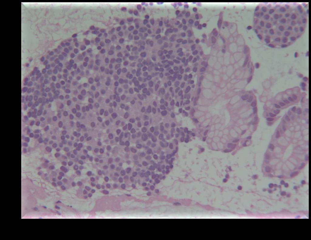 Padrão histológico Reconhecer um NET HE Padrão monótono Trabecular Tubulo-Acinar Sólido