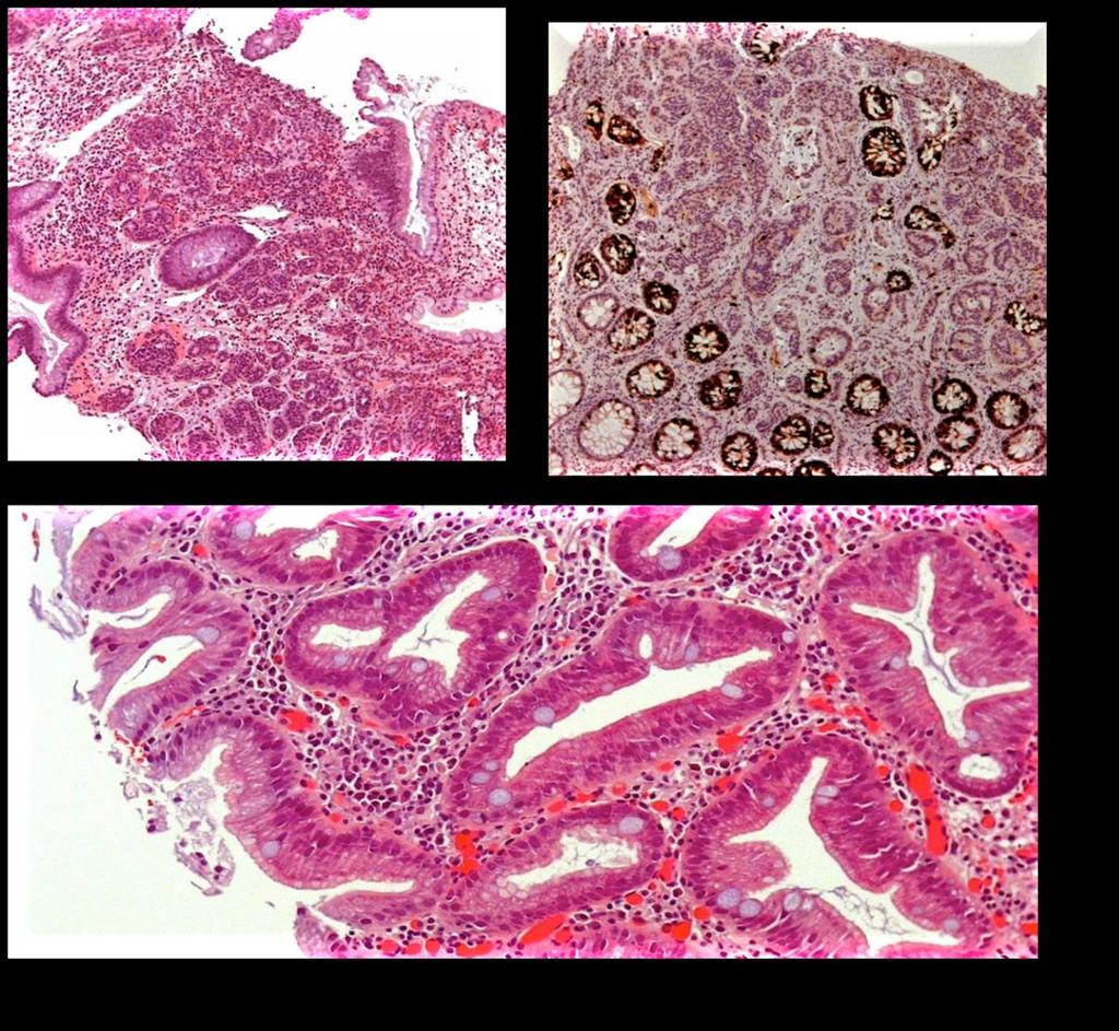 Biopsia gástrica MI Ki 67 Corpo gástrico NET