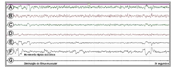 INTRODUÇÃO Polissonografia (Registro de uma época, apresentando o estágio REM, caracterizado pela movimentação rápida dos olhos e diminuição do tônus muscular.