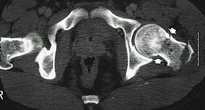 Femoral: