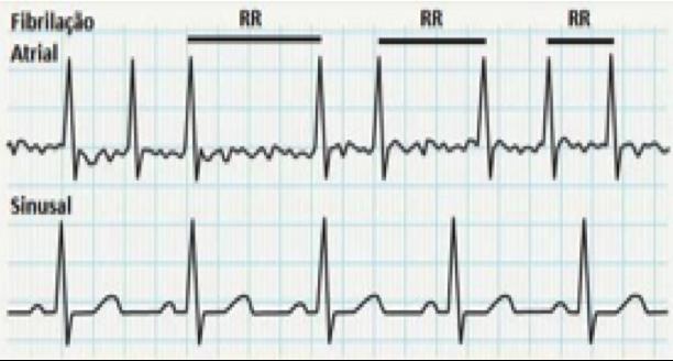 Arritmias Cardíacas Introdução Chegamos a um segmento importante das questões de concursos sobre cardiologia: as arritmias.