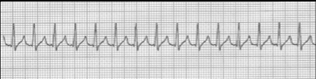 Taquicardia Supraventricular Paroxística ( Taqui-Supra/TSVP ) (Figura CA-AC-2) É caracterizada por: - Complexo QRS estreito - Ausência de onda P - Intervalos RR regulares Fisiopatogenia, clínica e