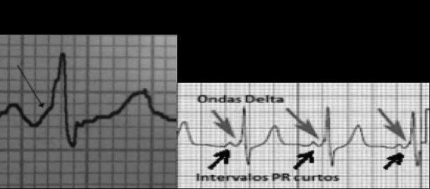 Síndrome De Wolff-Parkinson-White (WPW) Seu diagnóstico ao ECG é feito através de: - Presença de Onda Delta -Intervalo PR curto(<120ms) Seta: onda Delta É originada de uma via acessória congênita que