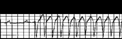 Taquicardia Ventricular (TV) Existem basicamente 4 subtipos de Taquicardias Ventriculares, que são: (1) Taqui