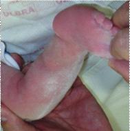 Conceito atualizado no tratamento do pé torto congênito idiopático Figura 5 e - Posicionamento em supinação (elevação da cabeça do primeiro metatarsal) necessário no método de Ponseti para a correção