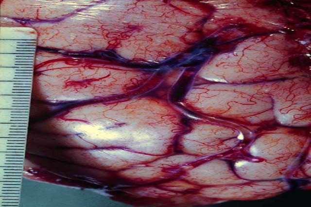 EMBOLIA SISTÊMICA:ÊMBOLOS ORIUNDOS DE ARTÉRIAS OU DO LADO ESQUERDO DO CORAÇÃO SEGUE PARA A "ÁRVORE ARTERIAL SISTÊMICA", NA DIREÇÃO DOS CAPILARES; COMUM NAS ENDOCARDITES VEGETATIVAS, NAS TROMBOSES