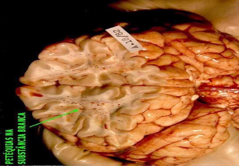 EMBOLIA GORDUROSA ÊMBOLO CEREBRAL COM