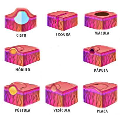Pl Considraçõs Grontólogicas As principais alterações na pele dos indivíduos idosos incluem ressecamento, enrugamento, pigmentação desigual e várias lesões proliferativas.