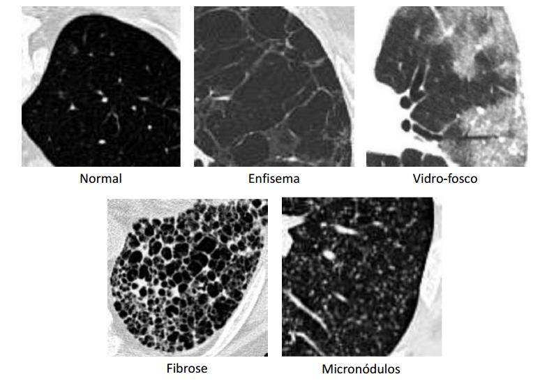 Padrões Pulmonares
