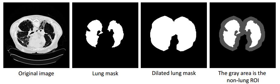 Extração de blocos de tecido não pulmonar Aplicação de dilatação morfológica na máscara do pulmão; A ROI não-pulmão é a área dilatada que não pertence a máscara