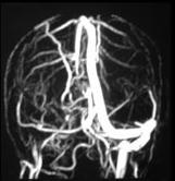 Trombose de