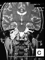 Neurinoma de glossofaríngeo Infarto