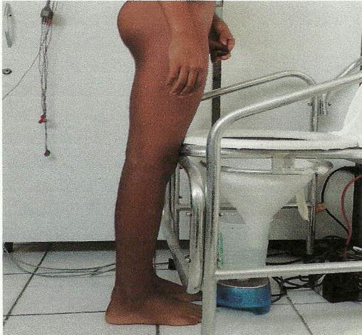 Foram excluídos os pacientes com distúrbios neurológicos associados ou alterações anatômicas do trato urinário, aqueles em que artefatos prejudicassem a avaliação do gráfico da EMG, os pacientes nos