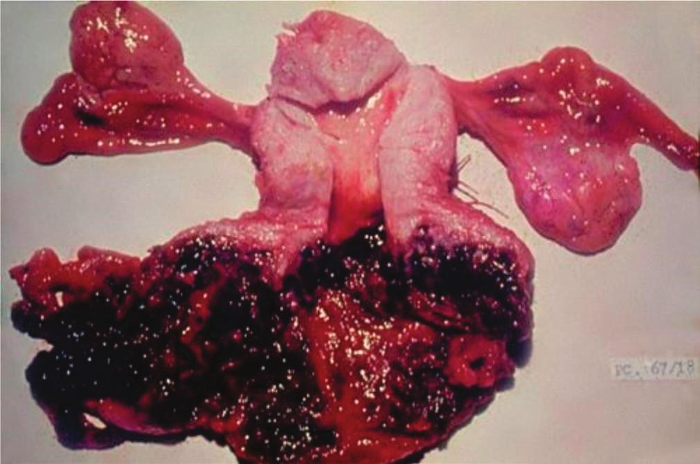 98 Lima Papel da cirurgia no manejo de mulheres com doença trofoblástica gestacional Figura 3. TTSP com extensa metástase vaginal.