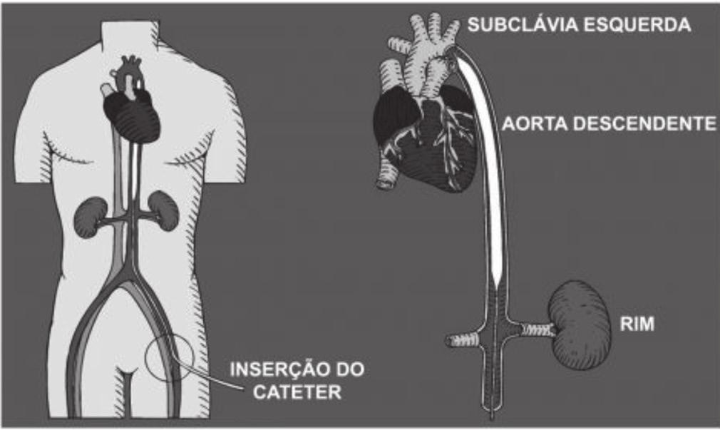 Thomaz Balão intra-aórtico no choque cardiogênico: o estado da arte 103 Figura 1. Posicionamento adequado do balão intra-aórtico.