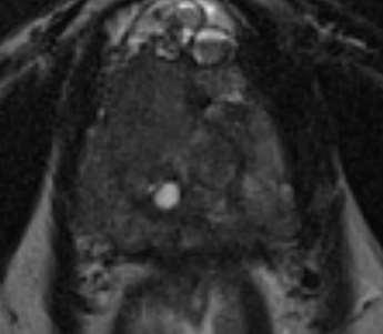 Estadiamento T Ápex invasão esfincter uretral externo Extensão extraprostática Contorno deformado, irregular