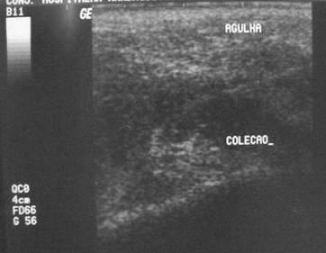 30 Figura 2.9 Ultra-sonografia. Existe uma área anecóica (escura) em espaço parotídeo esquerdo que representa a coleção de fluido.