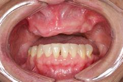 inferior parcialmente desdentado apresentando dentes em condição satisfatória (Figura 2). Figura 1 - Aspecto frontal da condição clínica inicial.