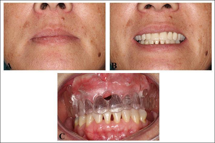 37 Figura 4 - Prova de dentes: A - Análise do suporte labial; B - Dimensão vertical de oclusão; C - Prova do guia multifuncional.
