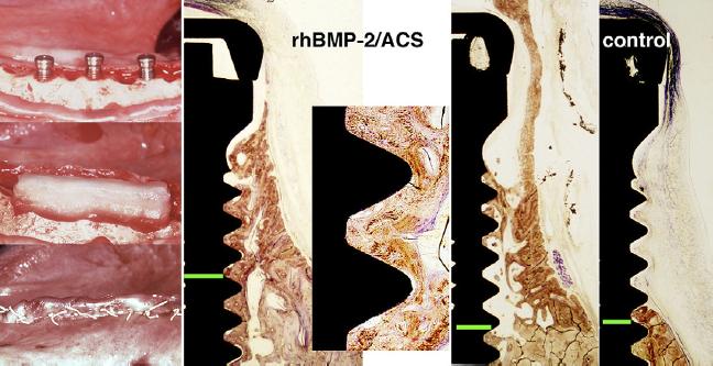 34 No estudo realizado por Wikesjo, et al. (2007), foram observadas as aplicações da BMP-2 para aumento ósseo alveolar e osseointegração dos implantes.