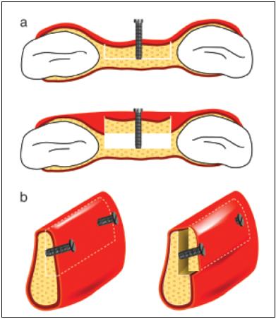 44 Figura 9: Gráfico ilustrando a visão bidimensional das osteotomias (a) (axial e lateral) e a translação vestibular do segmento(b); visão tridimensional das osteotomias (axial, lateral e