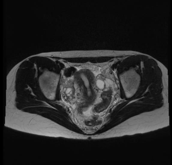 Figura 7 - Imagem de Ressonância magnética da pelve no plano axial ponderada em T2, demonstrando focos de endometriose