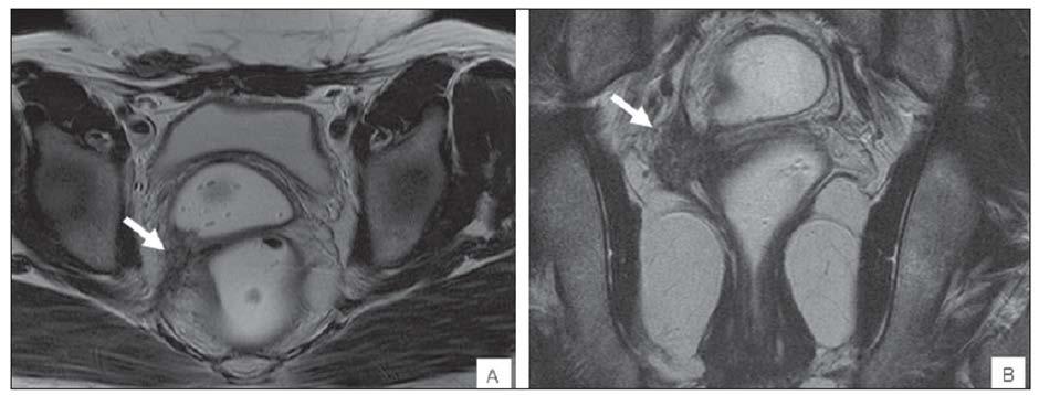 A RESSONÂNCIA MAGNÉTICA NO DIAGNÓSTICO DE ENDOMETRIOSE PROFUNDA COM ACOMETIMENTO INTESTINAL: RELATO DE CASO / THE MAGNETIC RESONANCE IN THE DIAGNOSIS OF DEEP ENDOMETRIOSIS WITH INTESTINAL