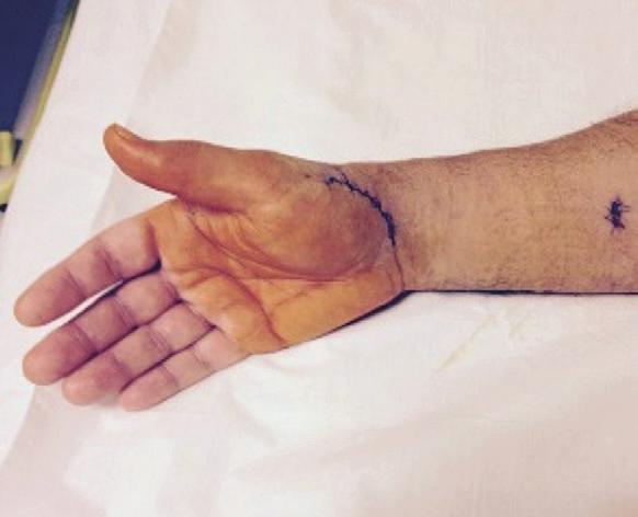 gessada do polegar ü Prescrição de tratamentos de fisioterapia ü Ensino em relação aos cuidados com a sutura SINAIS DE ALERTA - Febre - Dor intensa - Edema acentuado - Hemorragia - Alteração