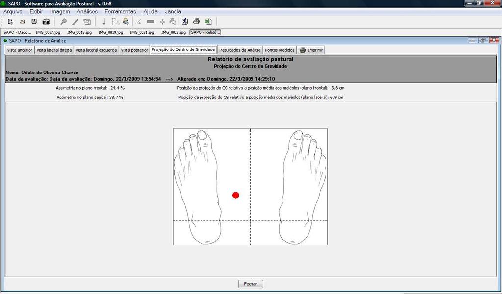 Anterior do Corpo Anteroversão Geno Recurvatum