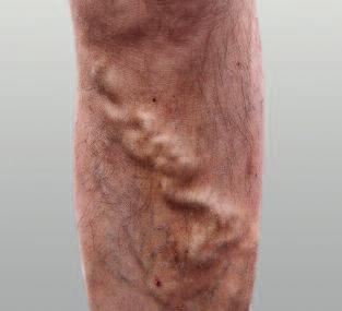 Derrames varicosos Os derrames varicosos são pequenas varizes dilatadas, na camada superior da pele, na maioria das vezes situadas nas pernas.