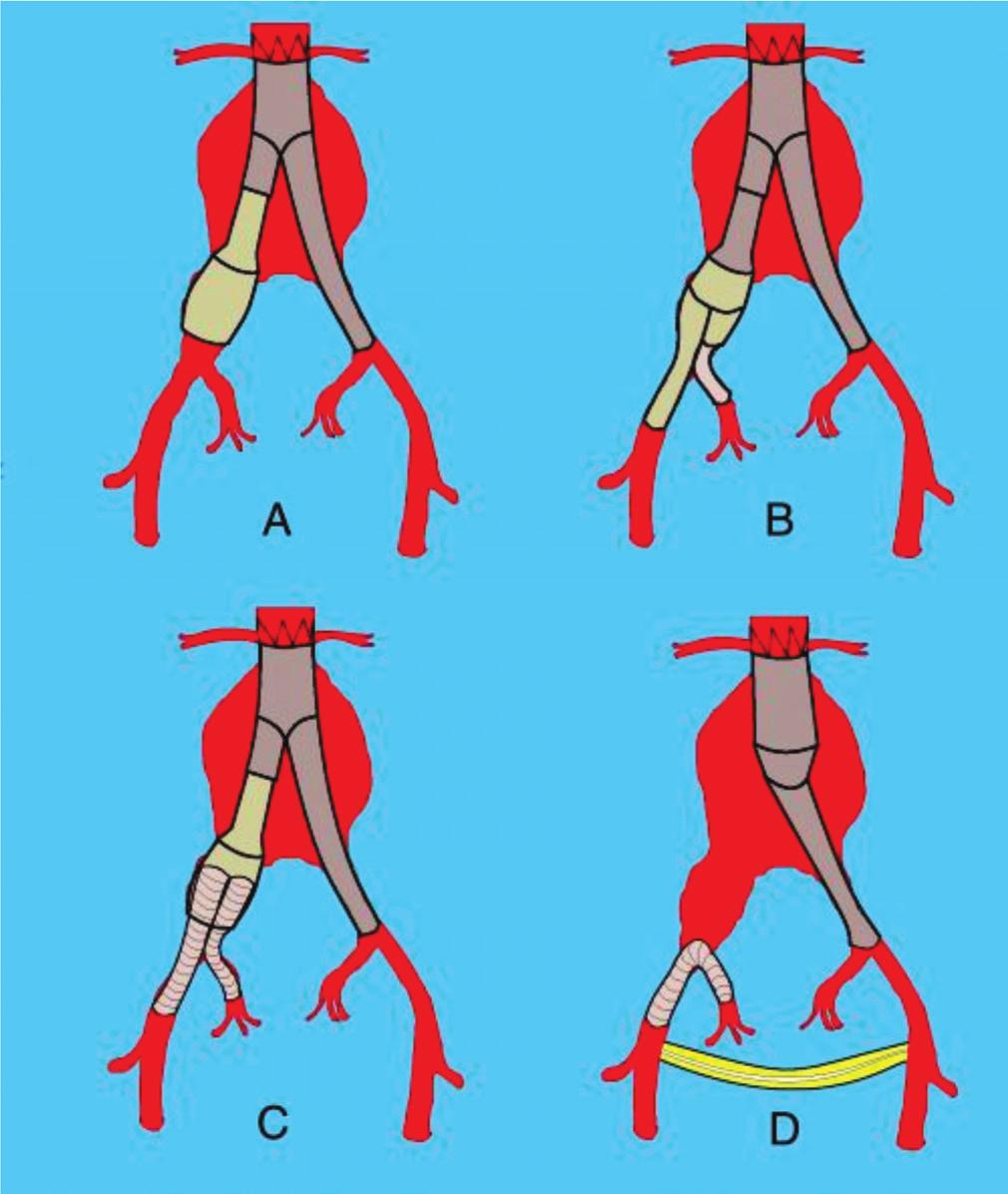 1cm em uma área da AIC ectasiada ou aneurismática (Figura 2A) 10. A presença de trombo no segmento ectasiado consiste em uma contraindicação à realização dessa técnica.
