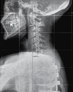 EVALUATION OF CERVICAL ALIGNMENT AND ITS RELATIONSHIP WITH THORACIC KYPHOSIS AND SPINOPELVIC PARAMETERS AFTER SCOLIOSIS EVALUATION CORRECTION OF SURGERY CERVICAL ALIGNMENT AND ITS RELATIONSHIP WITH