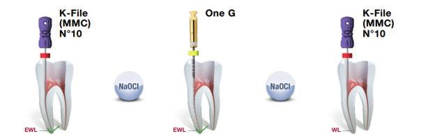 cm ONE G Especialmente Para a Criação do Glide Path Ideal para canais de difícil acesso (curvos, atrésicos e calcificados);