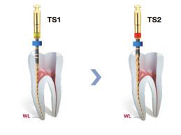 endodontia 2SHAPE Para a Instrumentação, Modelagem e Descontaminação do Conduto Radicular Sequência de duas limas em rotação contínua, diretamente no