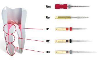 endodontia R ENDO Método Eficiente e Protocolo Simples Para Retratamento Endodôntico com Máxima Segurança 5