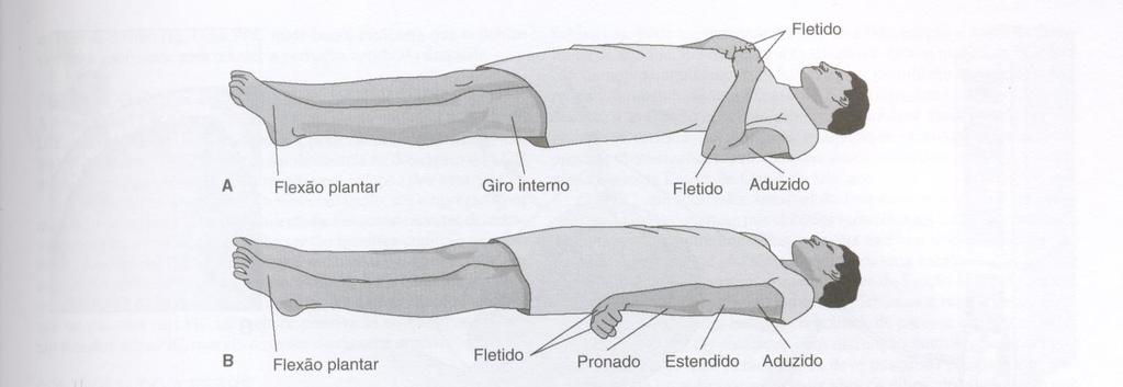 LÍQUOR EXPOSIÇÃO DE TECIDO CEREBRAL