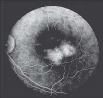 mácula. Podem ocorrer exsudatos lipídicos nas margens da área de telangiectasias tomando forma de retinite circinata.