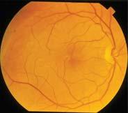 retinopatia diabética e retinopatia da irradiação.