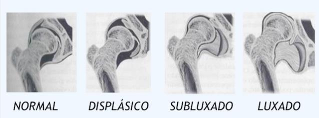 22 cabeça femoral, colo curto, trocanter posteriorizado, há encurtamento do nervo ciático, hipertrofia do músculo iliopsoas, horizontalização da musculatura abdutora e espessamento da cápsula