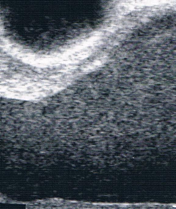 corno uterino com presença