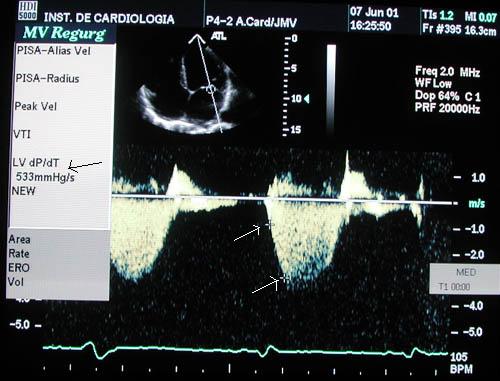 Cardiomiopatia Dilatada > 1000 mmhg/s