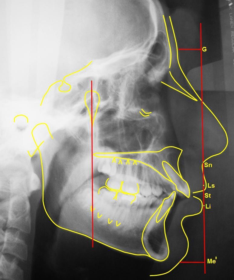 17 Figura 8 Medidas lineares do tecido mole da análise facial. Legenda: G Sn = altura do terço médio da face.