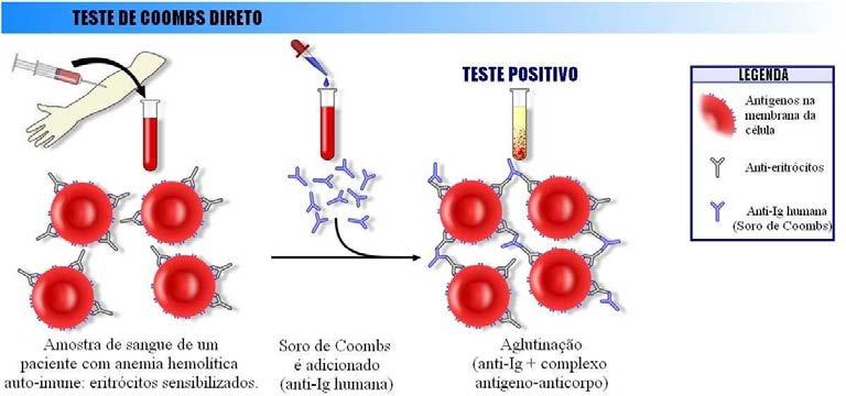 13 Figura 1: Teste de CoombsDireto (http://www.biomedicinapadrao.com.br/2010/11/testede-coombs-direto.