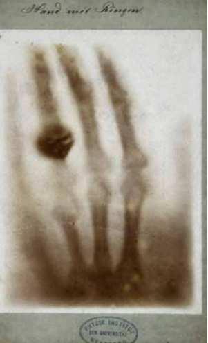 Monitorização na Medicina A origem da radiografia remonta à descoberta dos raio-x, logo após a descoberta desta, então, a enigmática radiação, foi descoberta com