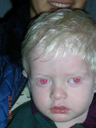 Os albinos sofrem consequências devido à falta de protecção contra a luz