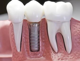 dentes adjacentes ou substitui devolvendo dentes função naturais mastigatória perdidos por e estética, dentes ajudando artificiais ea Exige -Doença -Disfunção -Saúde -Tomografia Implantes os Cirurgia