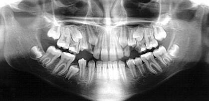 Radiografias As planejamento -Periapicais -Oclusais -Panorâmicas -Telerradiografias