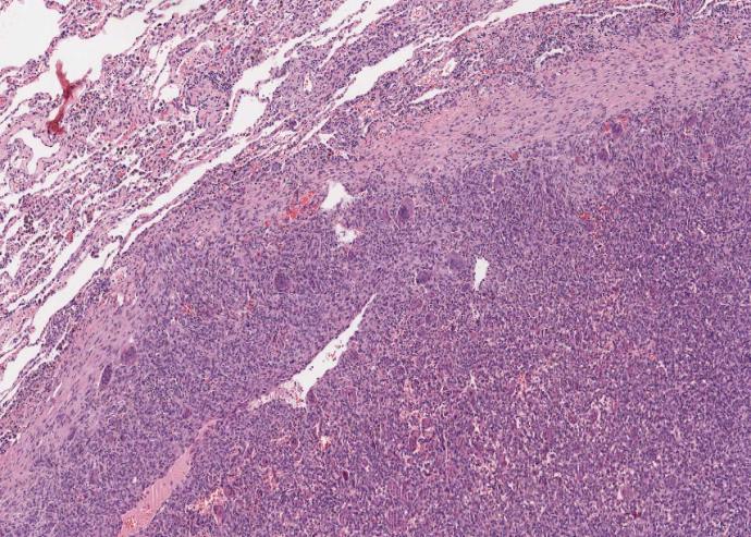 13 fig 2. Tumor de células gigantes no pulmão. Aumento 6,2x Em janeiro de 2009, foi submetida a toracotomia para ressecção da lesão em pulmão esquerdo, que confirmou lesão metastática.